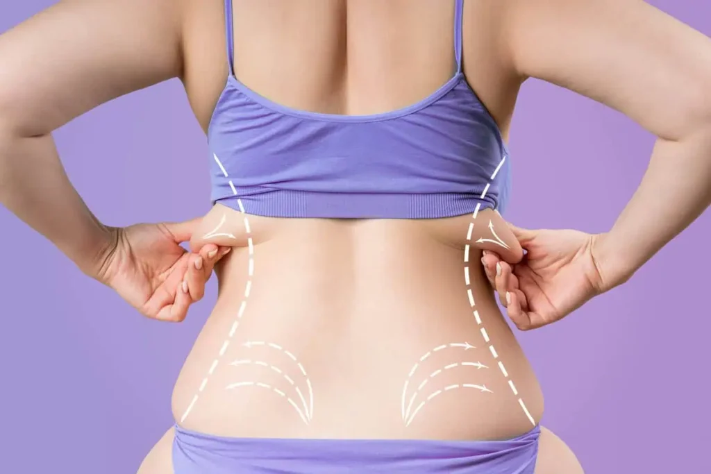Fat Reduction by contour lounge in Glendale, CA (1)